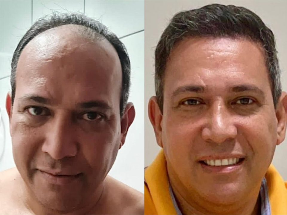 foto de resultado antes e depois de transplante capilar