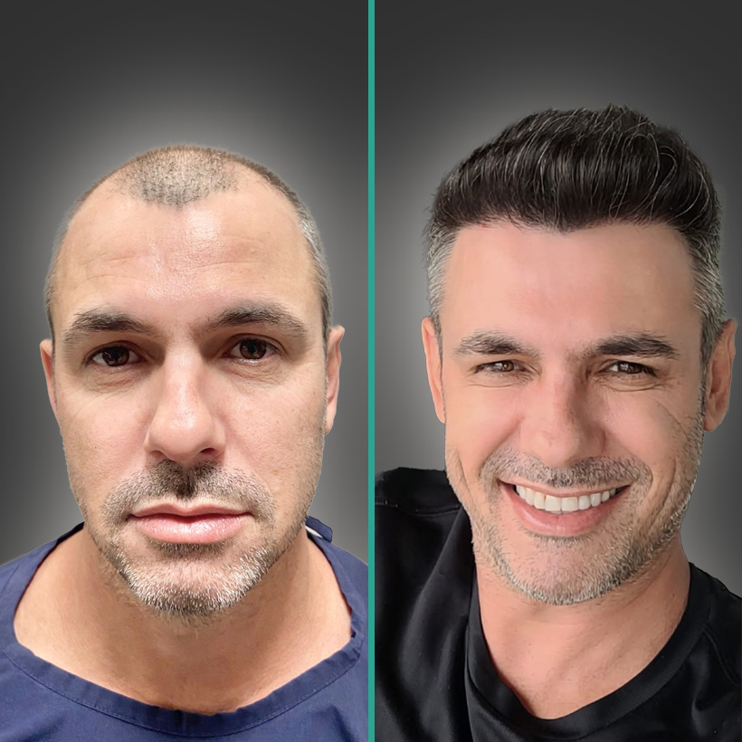 Antes e Depois 1
