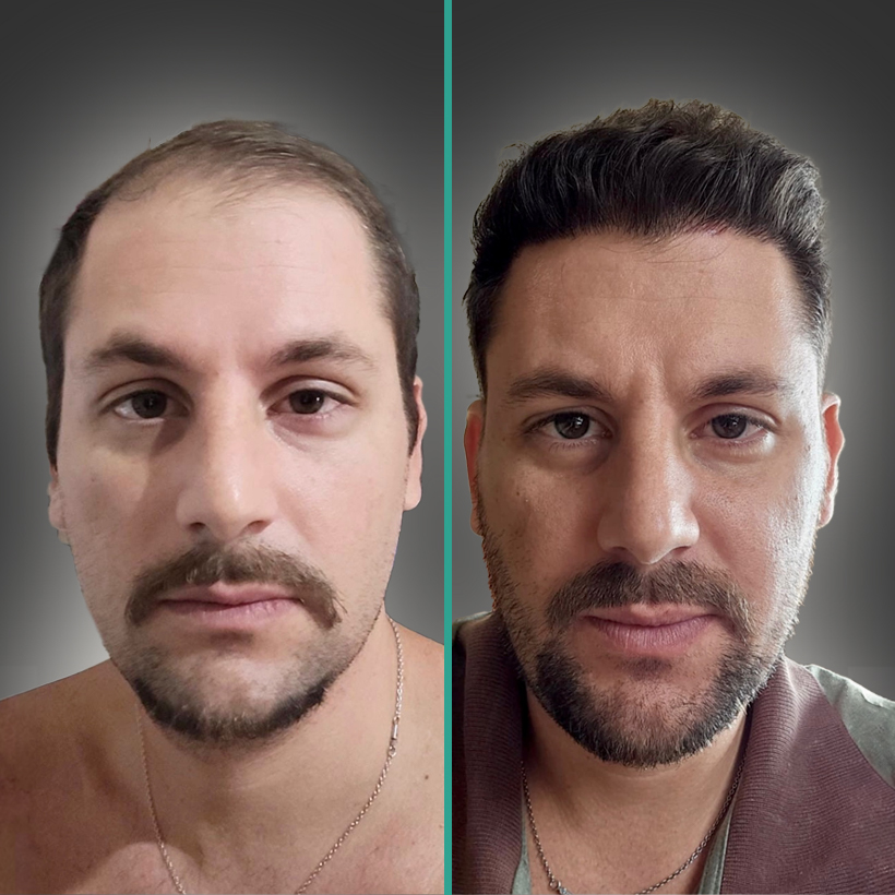Antes e Depois 3