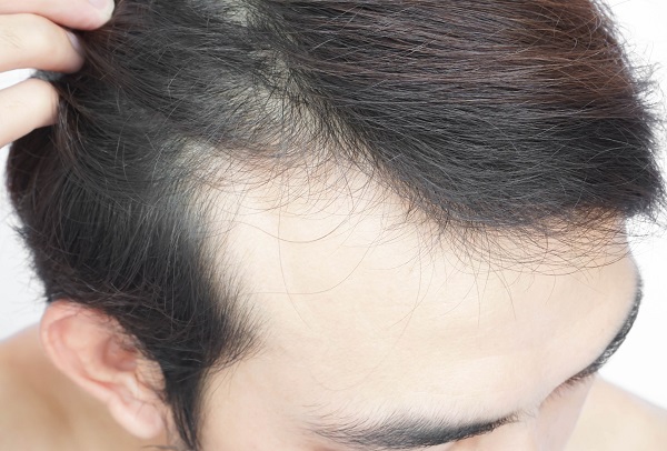 HAIRLINE TRANSPLANTE CAPILAR