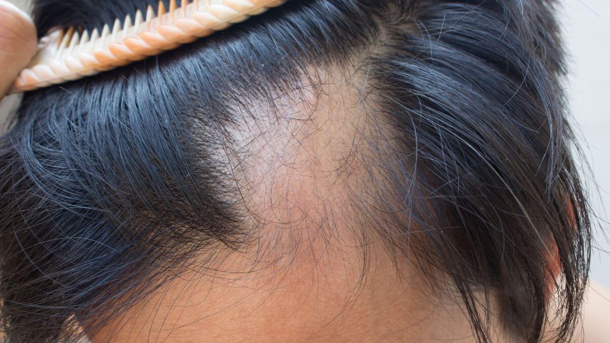 quando a queda de cabelo é preocupante