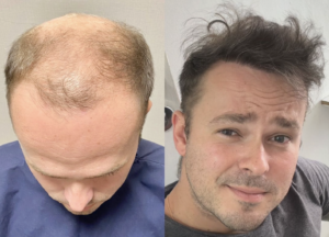 antes e depois transplante capilar