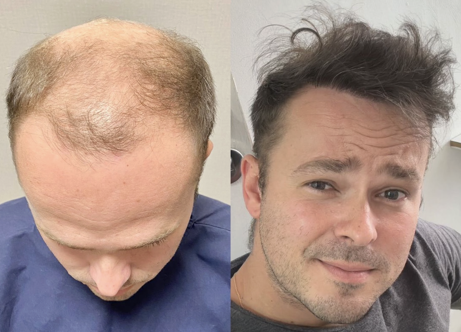 antes e depois transplante capilar