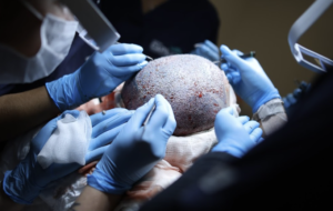 transplante capilar em 2026